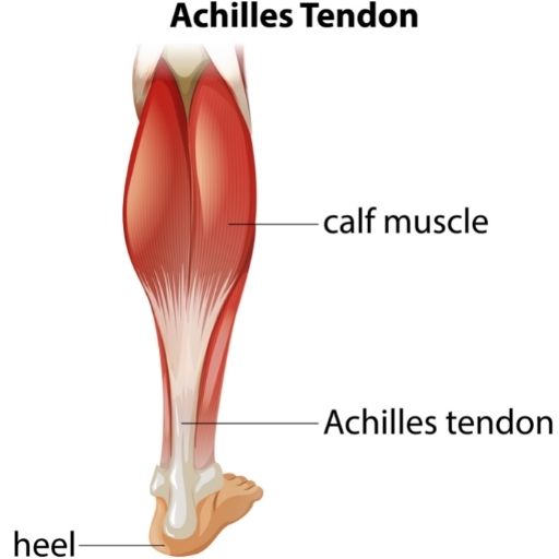 What is Achilles tendonitis