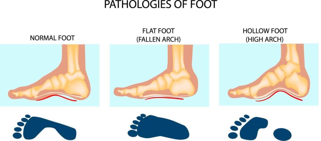 difference between high arch feet and normal feet
